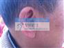 瑞声达恩佐儿童助听器上海特价一级授权宁耳最便宜