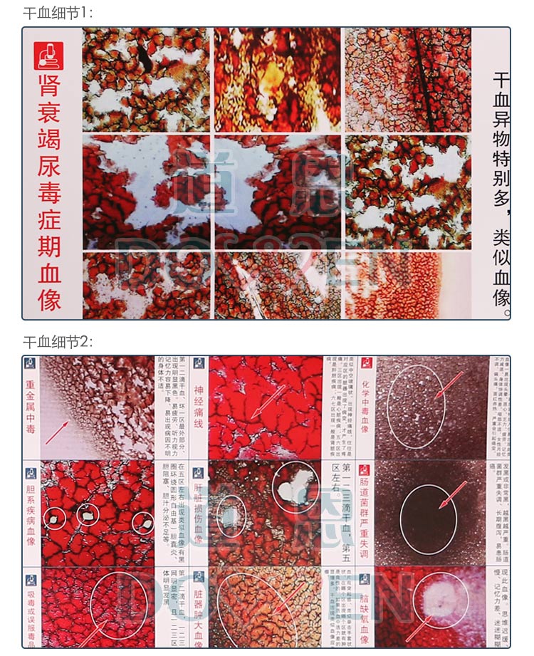 道恩黑背景305一滴血检测仪 挂图 小图 血液对比图  耗材