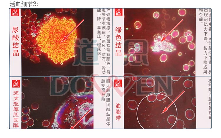 道恩黑背景305一滴血检测仪专用 挂图 大图 干活血对比图  耗材