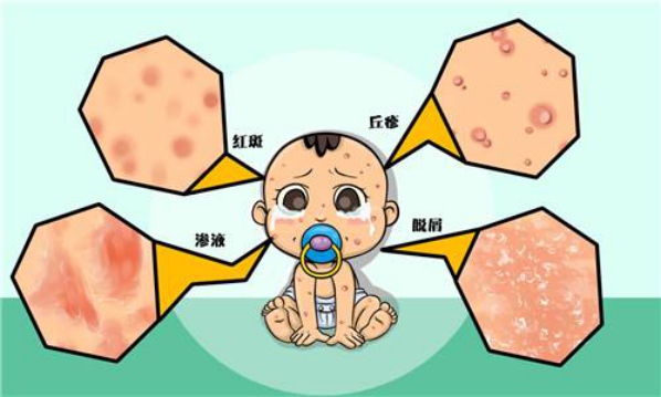 湿疹吃什么_湿疹如何方法_如何防治湿疹&nbsp;&nbsp;厂家价格