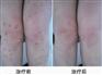 脚上长了湿疹怎么办_湿疹方案_怎么样才能