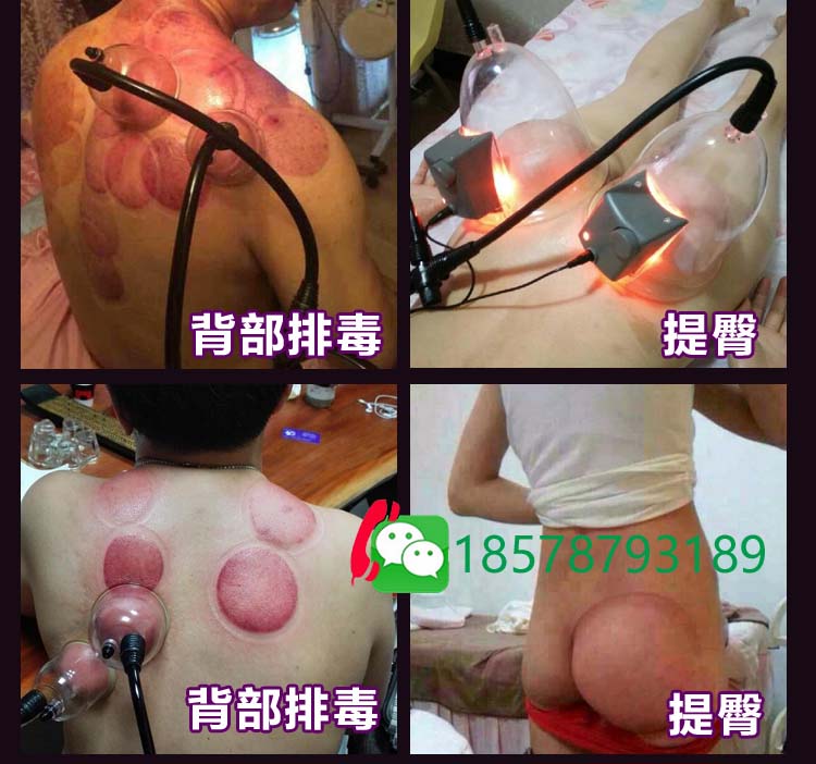 碧泼庭负压仪效果  碧泼庭厂家